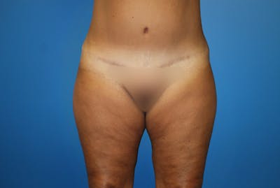 Liposuction Before & After Gallery - Patient 126926 - Image 1