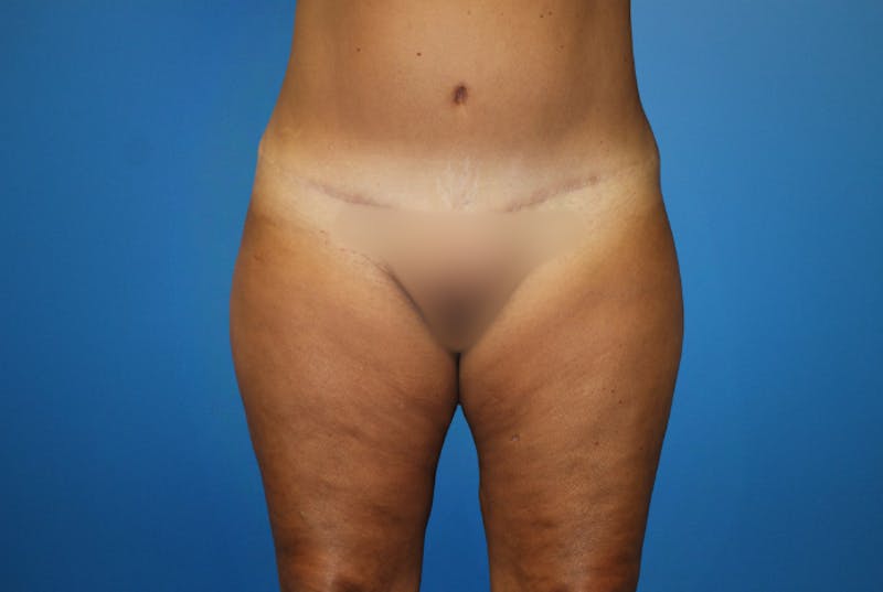 Liposuction Before & After Gallery - Patient 126926 - Image 1