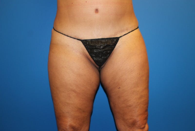 Liposuction Before & After Gallery - Patient 126926 - Image 2