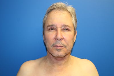 Facelift Before & After Gallery - Patient 692361 - Image 2