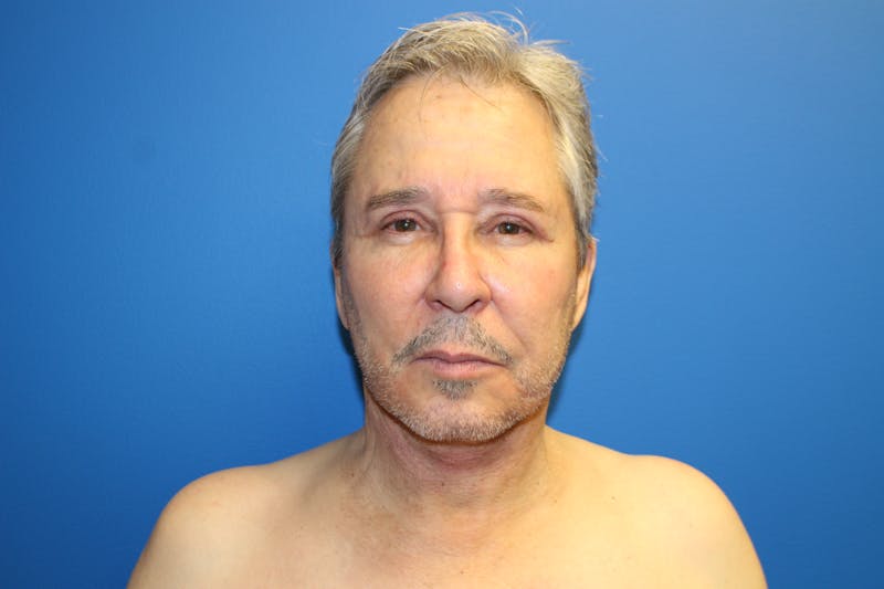 Facelift Before & After Gallery - Patient 692361 - Image 2