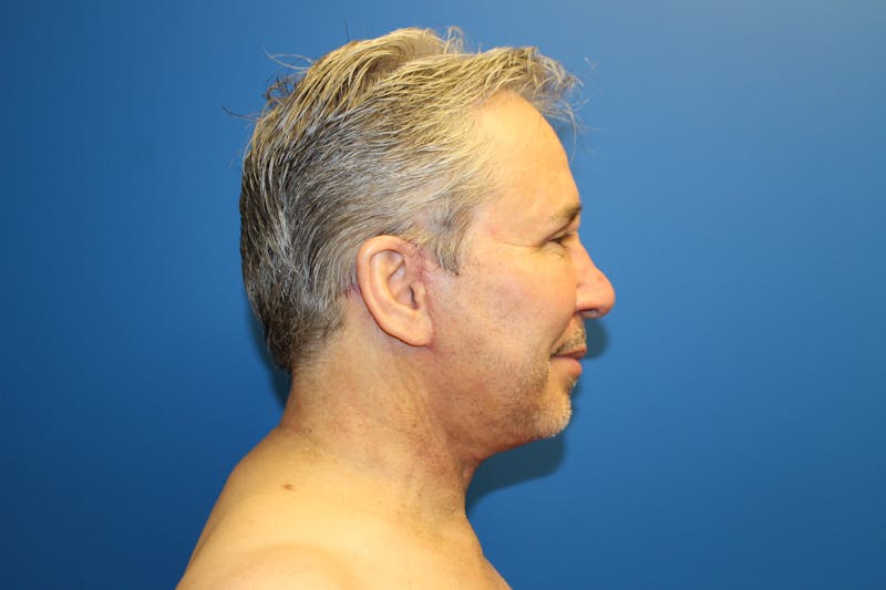 Facelift Before & After Gallery - Patient 692361 - Image 4
