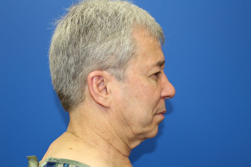 Facelift Before & After Gallery - Patient 692361 - Image 3