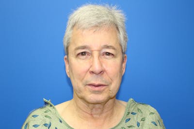 Facelift Before & After Gallery - Patient 692361 - Image 1