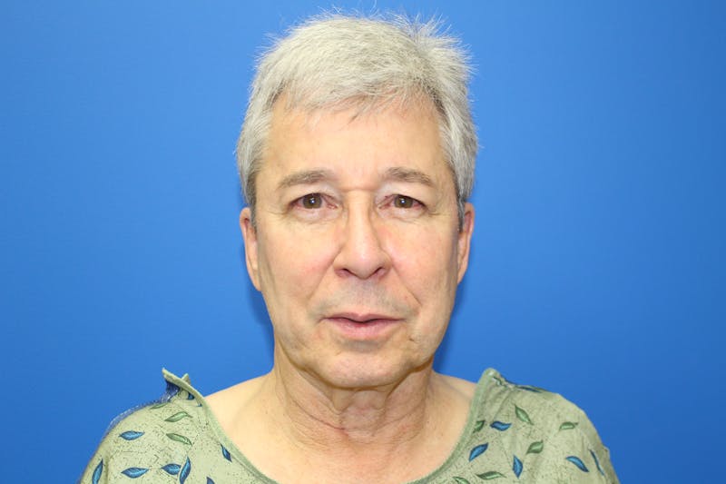 Facelift Before & After Gallery - Patient 692361 - Image 1