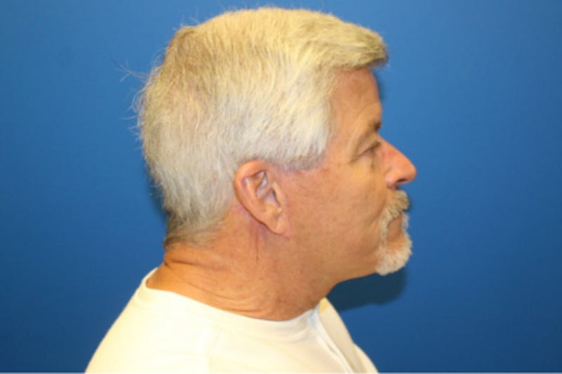 Facelift Before & After Gallery - Patient 377320 - Image 4