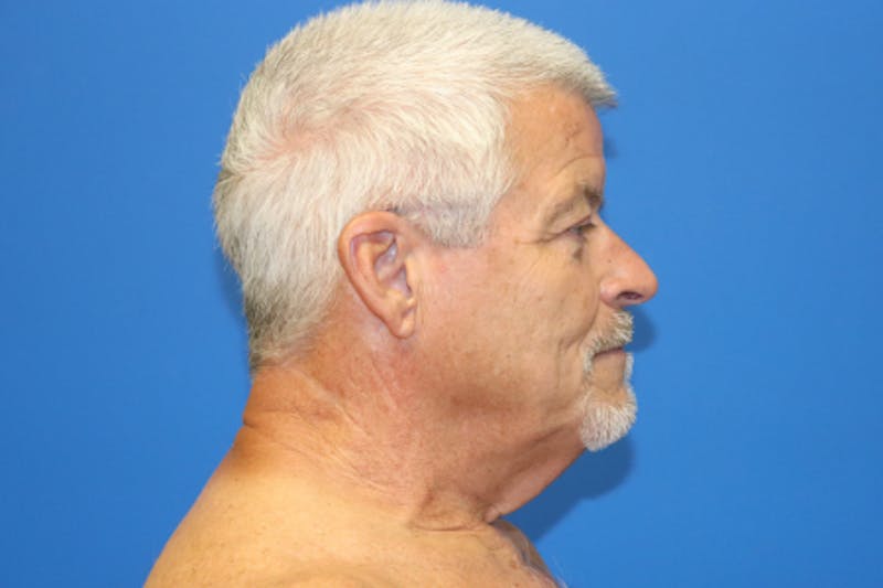 Facelift Before & After Gallery - Patient 377320 - Image 3