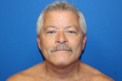 Facelift Before & After Gallery - Patient 377320 - Image 2