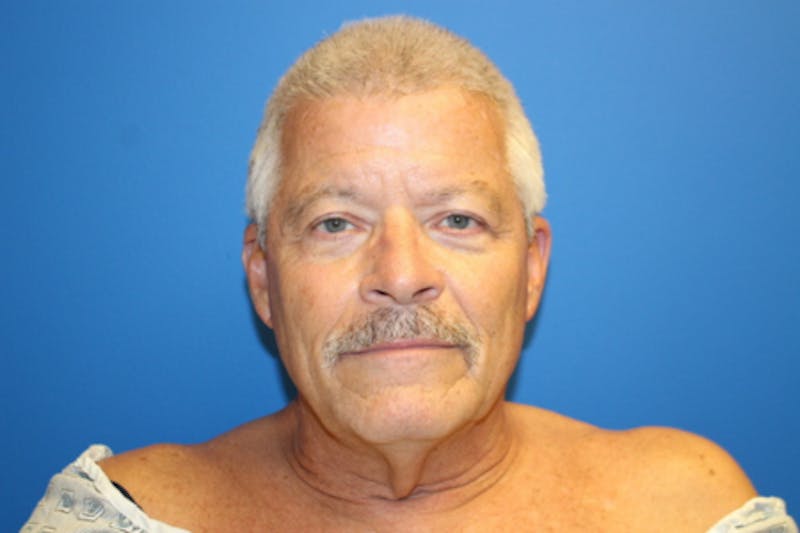 Facelift Before & After Gallery - Patient 377320 - Image 1