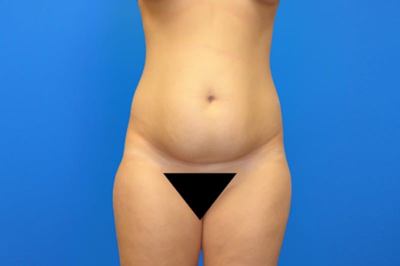 Abdominoplasty Before & After Gallery - Patient 223851 - Image 1