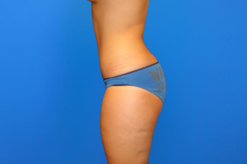 Abdominoplasty Before & After Gallery - Patient 223851 - Image 6