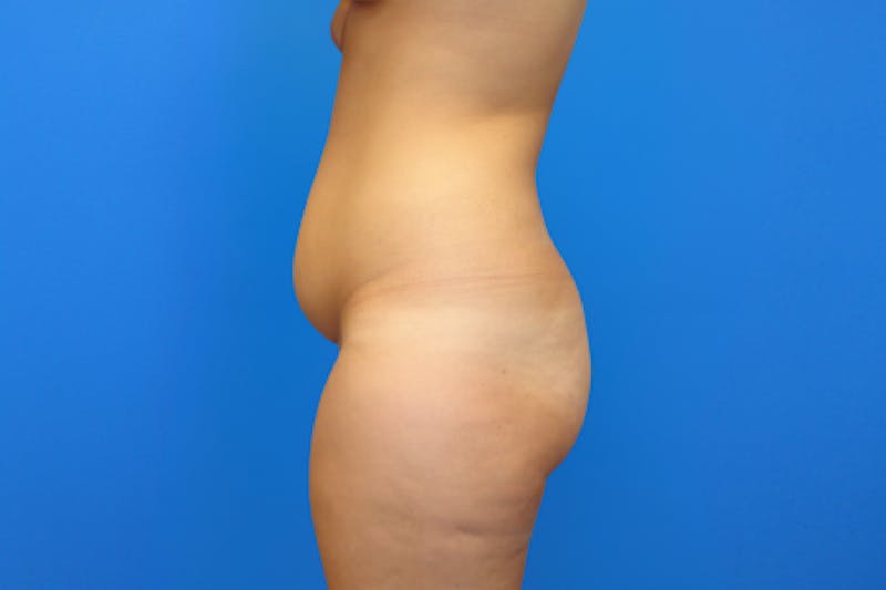 Abdominoplasty Before & After Gallery - Patient 223851 - Image 5