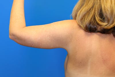 Brachioplasty Before & After Gallery - Patient 428159 - Image 2