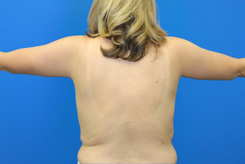 Brachioplasty Before & After Gallery - Patient 428159 - Image 6