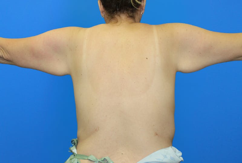 Brachioplasty Before & After Gallery - Patient 428159 - Image 5