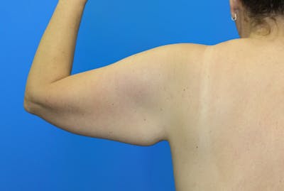 Brachioplasty Before & After Gallery - Patient 428159 - Image 1