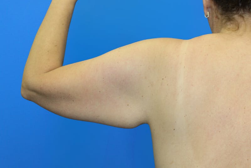 Brachioplasty Before & After Gallery - Patient 428159 - Image 1