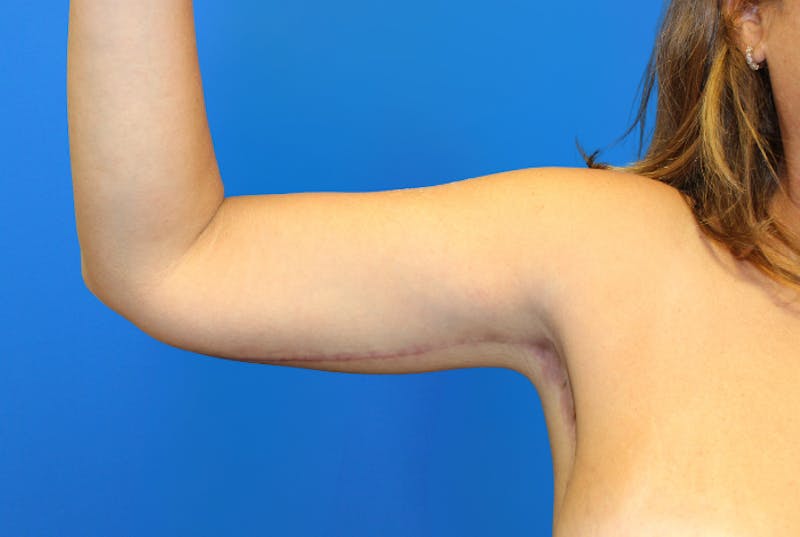 Brachioplasty Before & After Gallery - Patient 428159 - Image 4