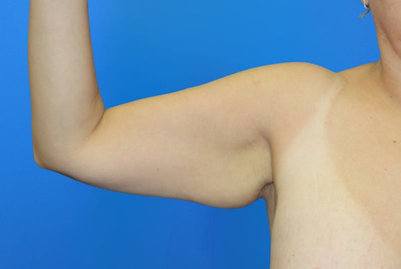 Brachioplasty Before & After Gallery - Patient 428159 - Image 3