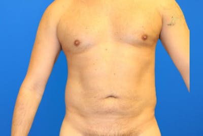 Liposuction Before & After Gallery - Patient 114807 - Image 2