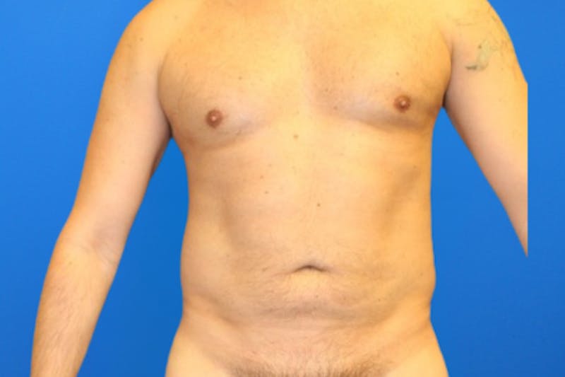 Liposuction Before & After Gallery - Patient 114807 - Image 2