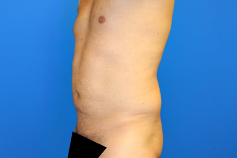 Liposuction Before & After Gallery - Patient 114807 - Image 6