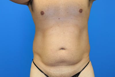 Liposuction Before & After Gallery - Patient 114807 - Image 1