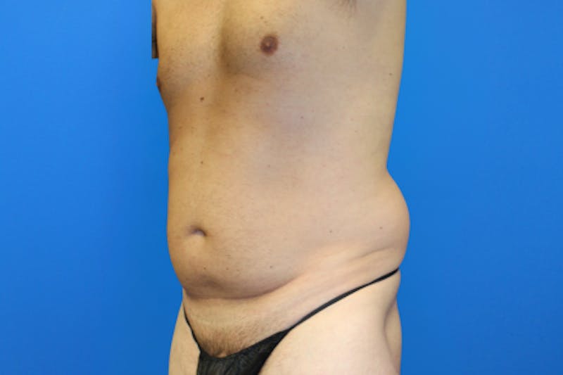 Liposuction Before & After Gallery - Patient 114807 - Image 5