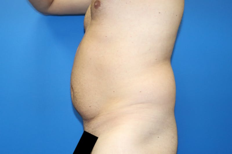 Liposuction Before & After Gallery - Patient 114807 - Image 3