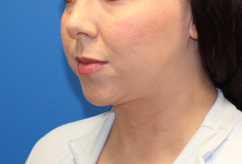 Neck Lift Before & After Gallery - Patient 108798 - Image 4