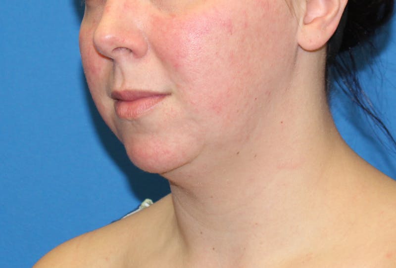 Neck Lift Before & After Gallery - Patient 108798 - Image 3