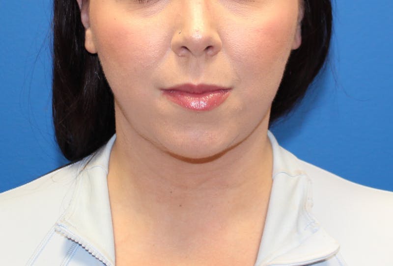 Neck Lift Before & After Gallery - Patient 108798 - Image 6