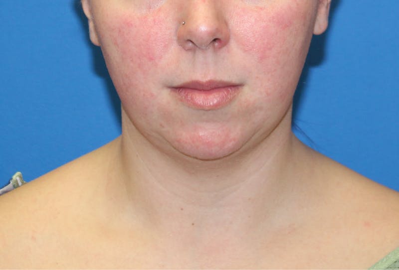 Neck Lift Before & After Gallery - Patient 108798 - Image 5