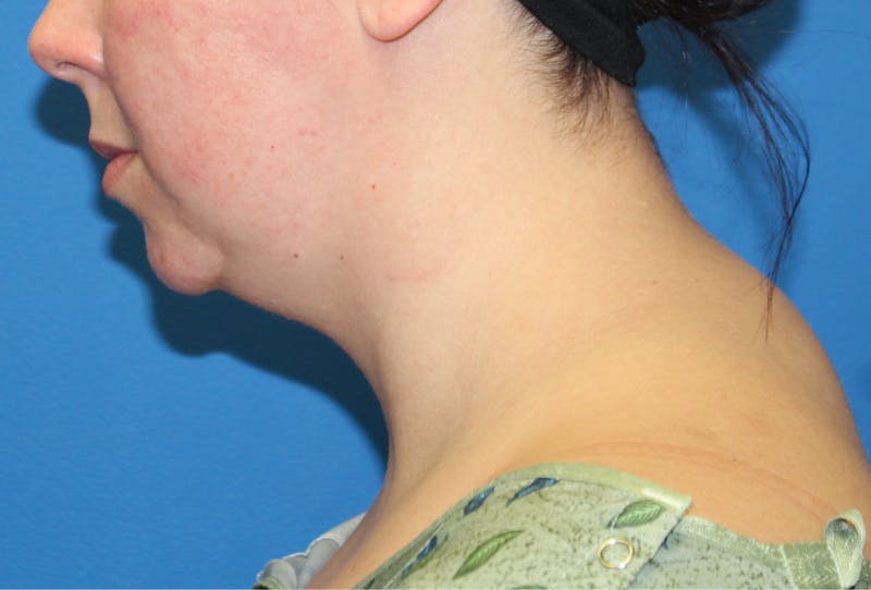 Neck Lift Before & After Gallery - Patient 108798 - Image 1