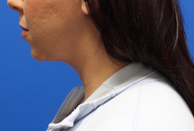 Neck Lift Before & After Gallery - Patient 108798 - Image 2