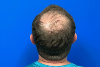 PRP Hair Restoration Before & After Gallery - Patient 423020 - Image 2