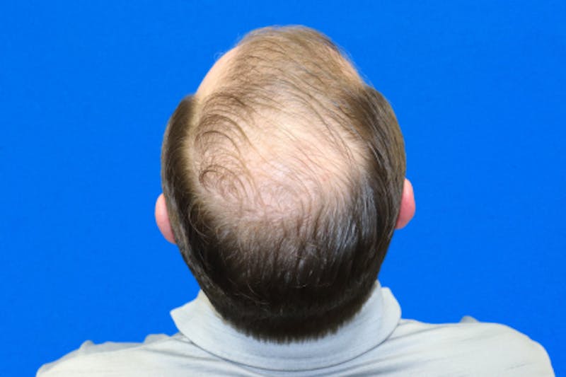 PRP Hair Restoration Before & After Gallery - Patient 423020 - Image 1