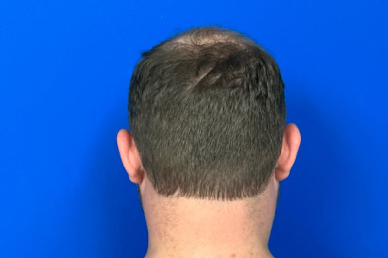 PRP Hair Restoration Before & After Gallery - Patient 423020 - Image 4