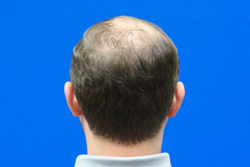 PRP Hair Restoration Before & After Gallery - Patient 423020 - Image 3