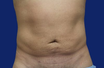 Skin Tightening Before & After Gallery - Patient 373094 - Image 1