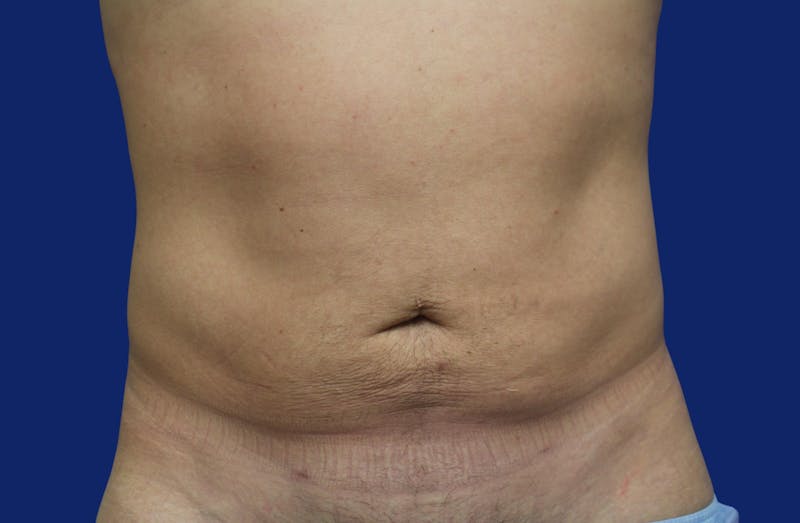 Skin Tightening Before & After Gallery - Patient 373094 - Image 1