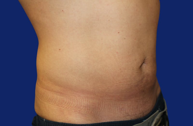Skin Tightening Before & After Gallery - Patient 373094 - Image 4