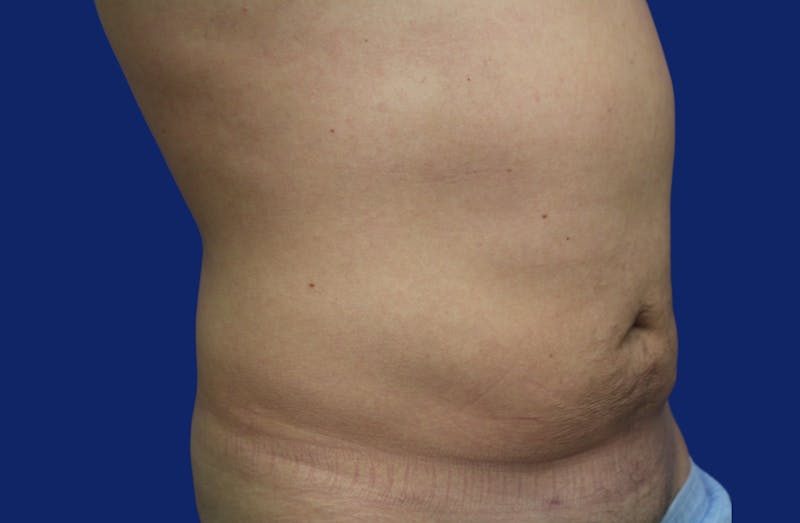 Skin Tightening Before & After Gallery - Patient 373094 - Image 3