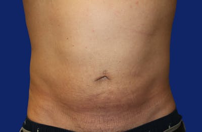 Skin Tightening Before & After Gallery - Patient 373094 - Image 2