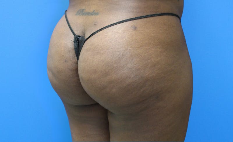 Brazilian Butt Lift Before & After Gallery - Patient 329419 - Image 4