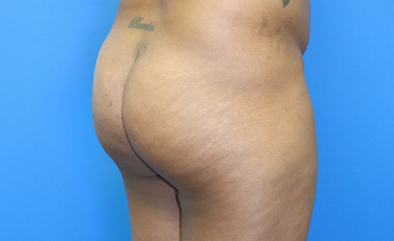 Brazilian Butt Lift Before & After Gallery - Patient 329419 - Image 3