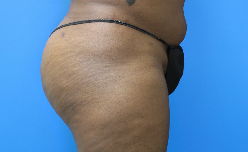 Brazilian Butt Lift Before & After Gallery - Patient 329419 - Image 6