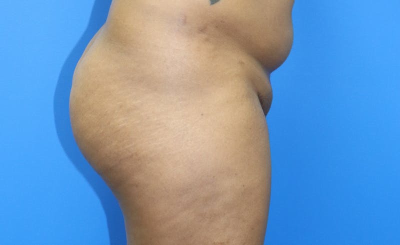 Brazilian Butt Lift Before & After Gallery - Patient 329419 - Image 5