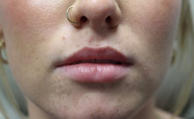 Facial Fillers Before & After Gallery - Patient 938305 - Image 1