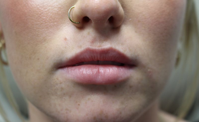 Facial Fillers Before & After Gallery - Patient 938305 - Image 1